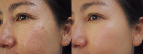 uses of retinol in skincare