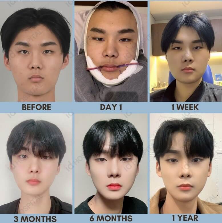 korean male actors plastic surgery before and after