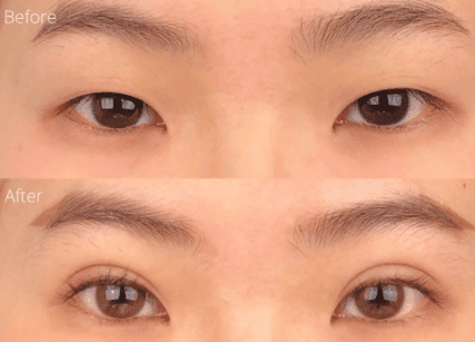 非切開式二重まぶた手術
