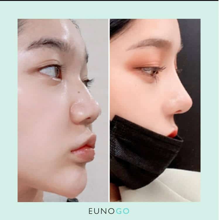 how common is plastic surgery in korea